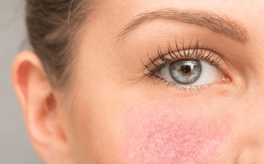 Hvad er rosacea, og hvordan kan LED-lysterapi hjælpe?