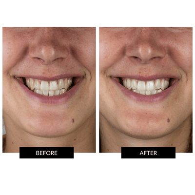 CurrentBody Skin Tandblegningssæt