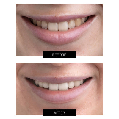 Currentbody Skin Tandblegning Gel Genopfyldningssprøjter 5ml