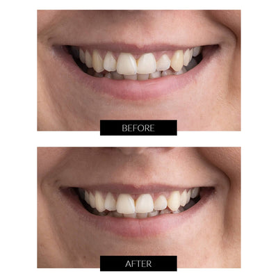 Currentbody Skin Tandblegning Gel Genopfyldningssprøjter 5ml