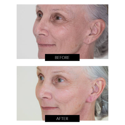 Før og efter billeder efter behandling med NIRA Pro Skincare Laser