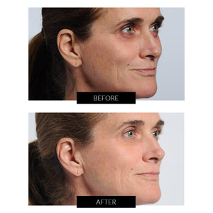 Behandling med NIRA Pro Skincare Laser, før og efter billeder