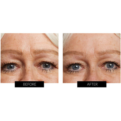Før og efter billede efter brug af Dr. Harris Anti-Wrinkle Sovemaske