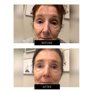 Før og efter billeder efter behandling med LYMA laseren i ansigtet