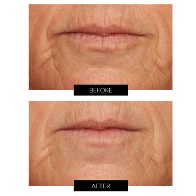 Før og efter billede af behandling omkring læberne med Lancer Hudplejeprodukter