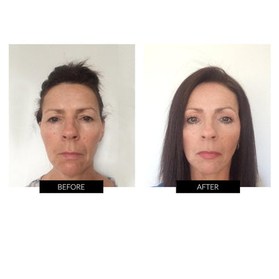 Før og efter billede efter behandling med NuFACE Trinity