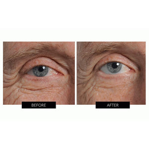 Før og efter billeder omkring øjnene efter behandling med Nira Skincare laser