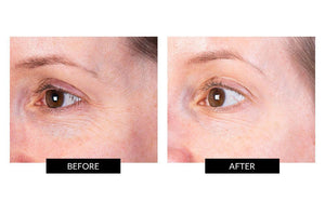 Før og efter billeder efter behandling med Nira Skincare laser omkring øjnene