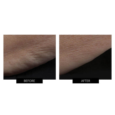 Før og efter billede af armen efter behandling med NuBODY
