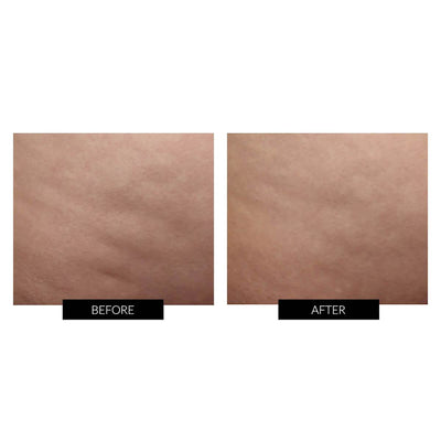 Før og efter billede efter behandling med NuBODY Skin